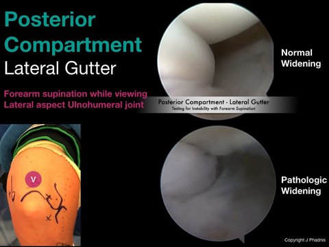 Arthroscopic Diagnosis of Posterolateral Rotatory Instability of the ...