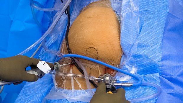 Endoscopic Partial Proximal Hamstring Repair | Vumedi