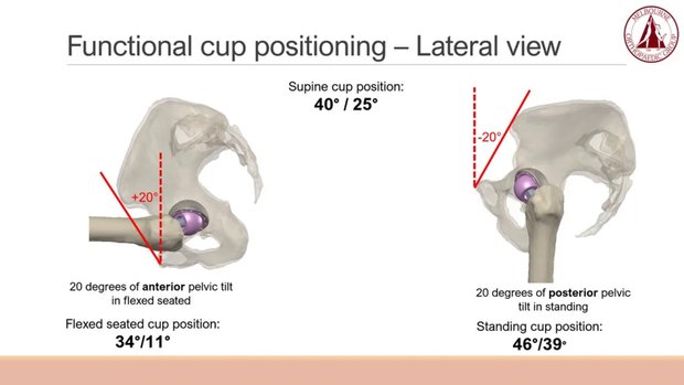 What Is Functional Cup Positioning? How Do Changes in Sagittal Pelvic ...