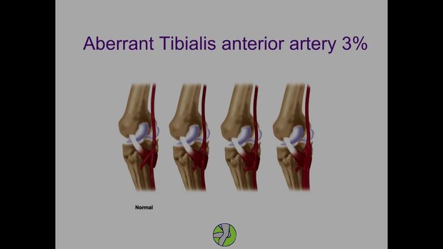 Osteotomy of the Knee: Indications, Techniques and Outcomes | Vumedi