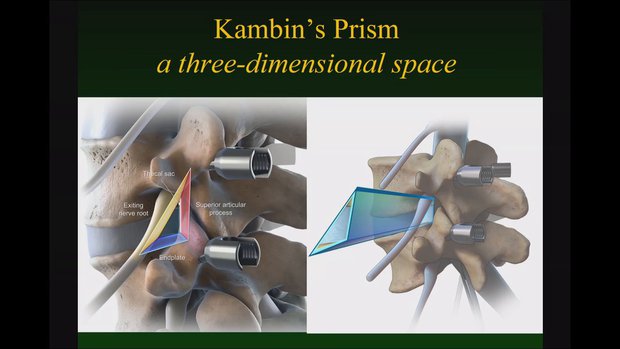 Kambin's Triangle: A New Classification. Why to Do Endoscopic Surgery ...