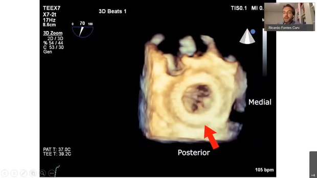 An Unusual Case of Bioprosthetic Mitral Valve Failure: the Importance ...