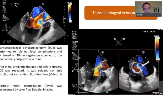 Valvular Disease Begets Valvular Disease: How to Diagnose and Document