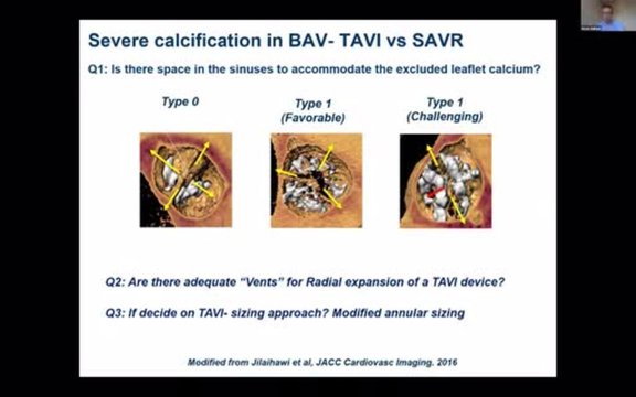 Pre-procedural Planning for TAVI: How to Evaluate the Aortic Valve CT ...