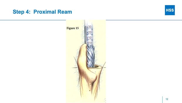 Femoral Component Revision with Modular Tapered Stems: Technique ...