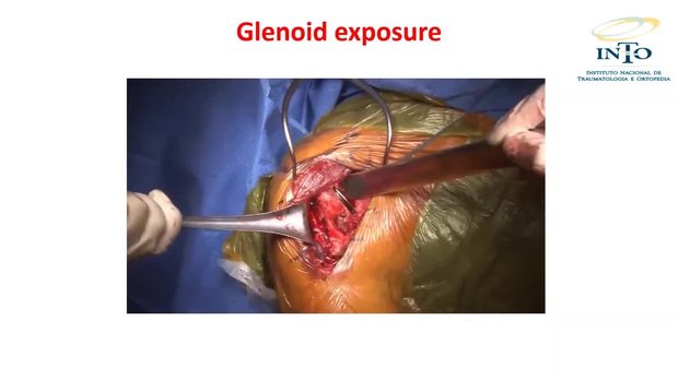 Technical Tips for Total Shoulder Arthroplasty | Vumedi