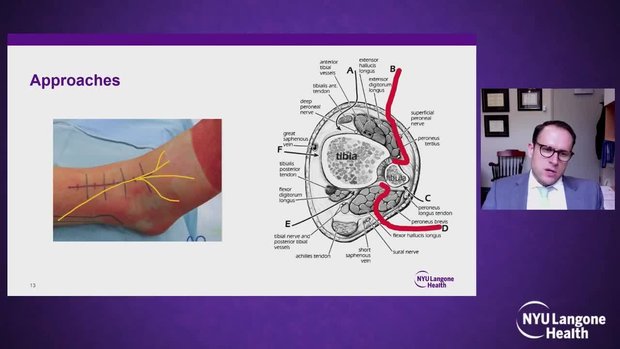 Pilon Fractures: Tips and Tricks | Vumedi