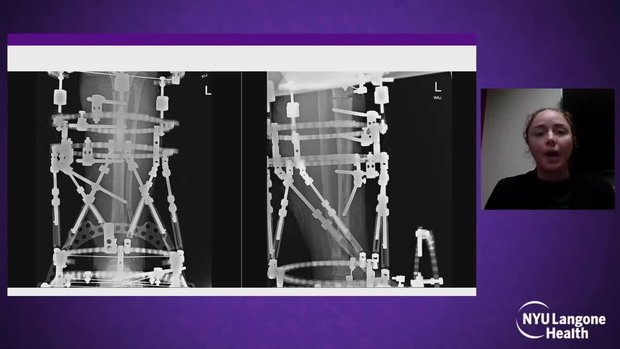 Pilon Fracture Complications: How to Avoid and How to Treat (CASES ...
