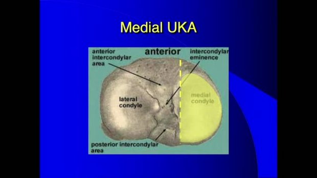 My Top 5 Moves in UKA: Do More UKAs, Do Lateral UKAs, Cut the Tibia ...