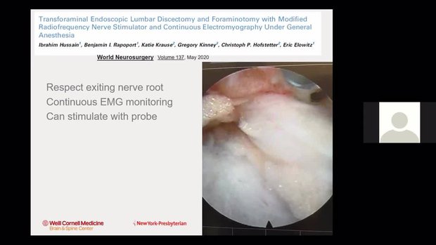 Endoscopic Transforaminal Lumbar Decompression: What Are the Major ...
