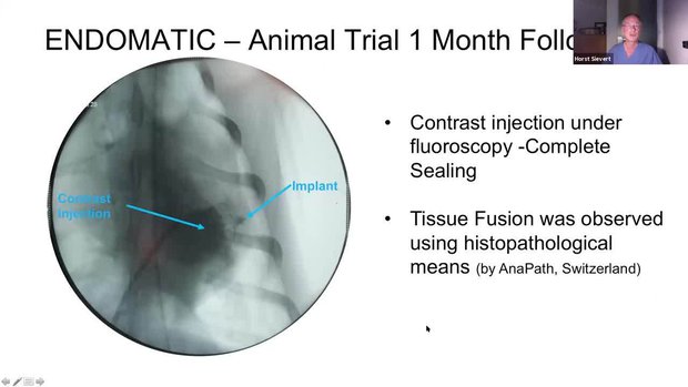 Endomatic Sepiola LAA Closure: Procedure & Acute Animal Trial Data | Vumedi