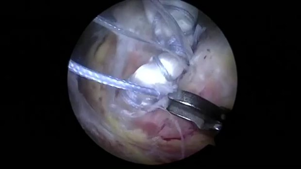 Arthroscopic Biceps Tenodesis Onlay Using Knotless Swivelock | Vumedi