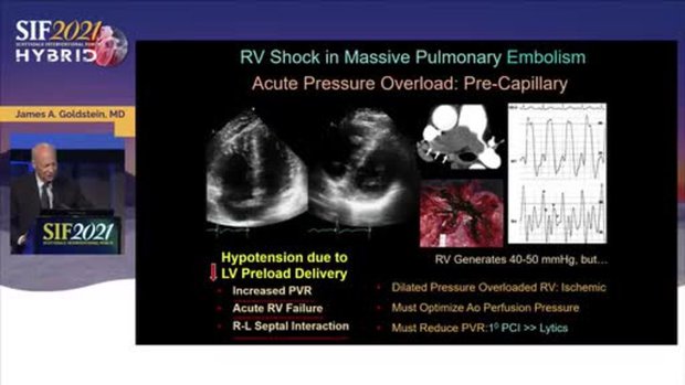 Recognition and Management of RV Failure | Vumedi
