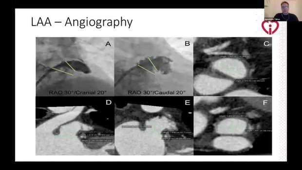 Step-by-step LAA Closure With Amulet: From Basic Pigtail Access to ...