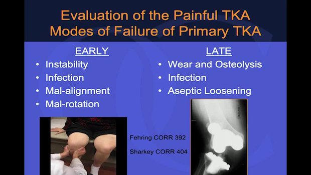 Evaluation of the Painful TKA: History, Physical Exam and Plain X-Rays ...