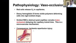 Pathophysiology of Sickle Cell Disease - Polymerization, Vaso-Occlusion ...