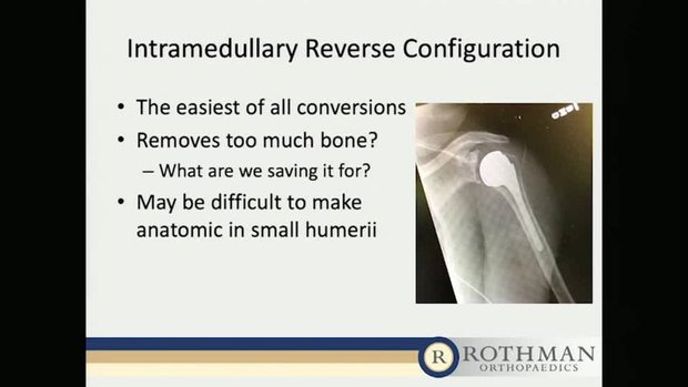 AltiVate Reverse Short Stem: Justification for the Use of Short Stem ...