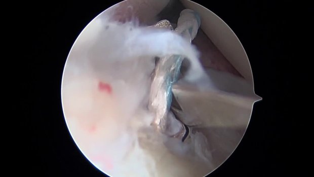 Arthroscopic McLaughlin Procedure | Vumedi