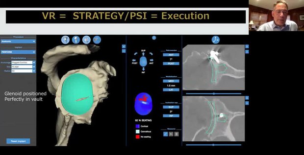 Preoperative Planning and What I Use to Determine TSA vs RSA | Vumedi