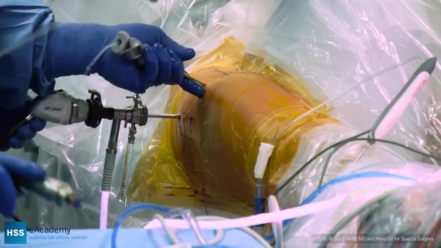 Arthroscopic Femoral Acetabular Impingement Surgery: Labral Repair and ...