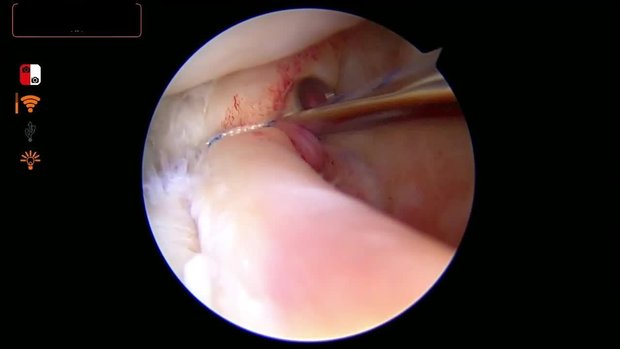 Arthroscopic Treatment of a GLAD Shoulder Injury | Vumedi