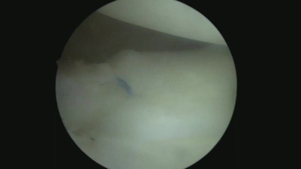 Both Posterior Root Lateral-Medial Meniscus Tears With