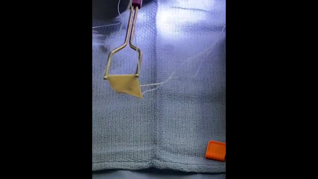 Revision Rotator Cuff With New Arthrex Cuffmend & Tissue Tak Patch ...