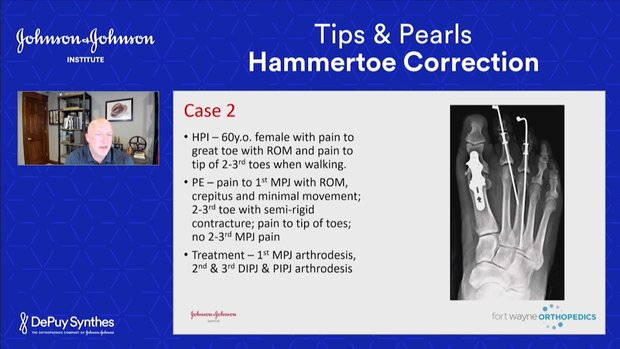 Hammertoe Correction with the Hammertoe Continuous Compression Implant ...