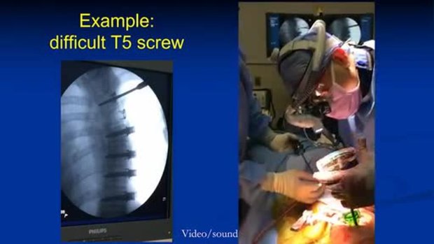 Open Approach for Anterior Scoliosis Correction (ASC) | Vumedi