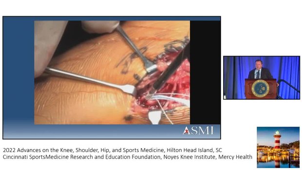UCL Repair in the Overhead Athlete: Where Are We Today? | Vumedi