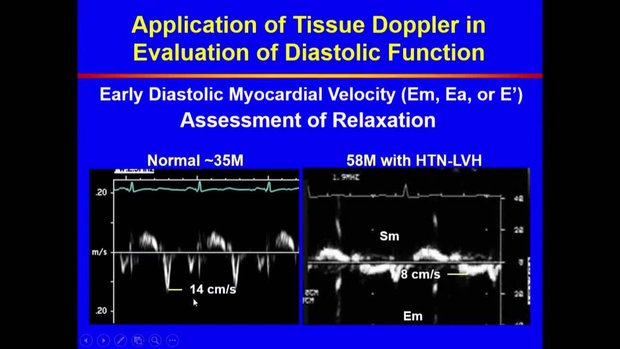 Evaluation of Left Ventricular Diastolic Function | Vumedi