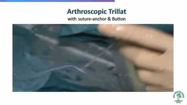 Results of Arthroscopic Trillat Procedure for Patients with Recurrent ...