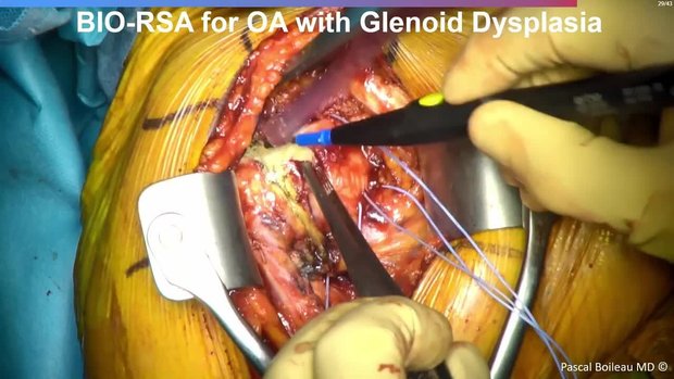 Managing Severe Glenoid Bone Loss & Erosion with the BIO-RSA | Vumedi