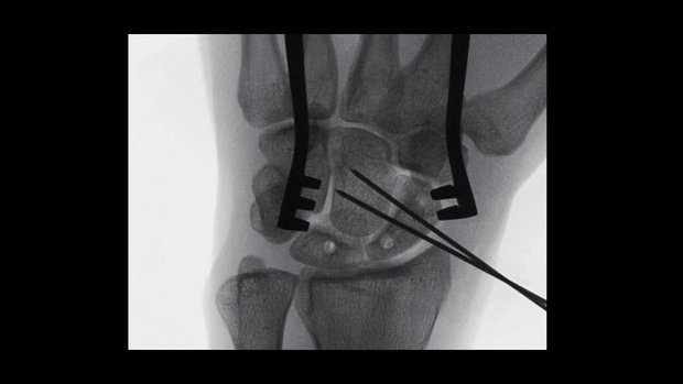 Scapholunate Ligament Reconstruction with an Internal Brace | Vumedi