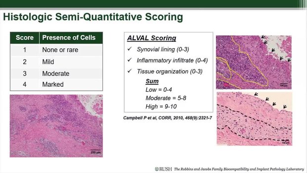MOP Patients with High ALVAL Tissue Scores Had CoCrMo Femoral Heads ...