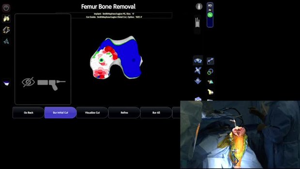 CORI: Robotic Assisted Revision Knee Arthroplasty (Live