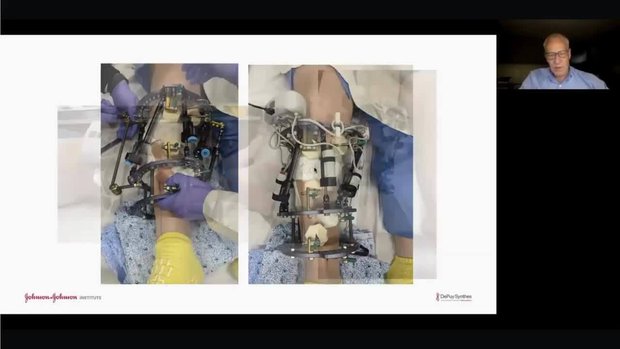 MAXFRAME AUTOSTRUT™ System Case Studies | Vumedi
