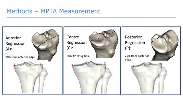 Novel Methodology for Measuring the Medial Proximal Tibial Angle in ...