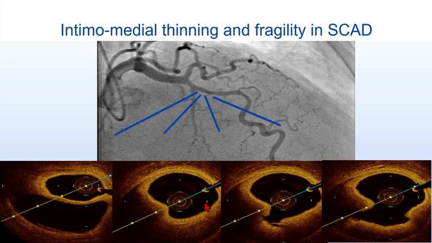 Management of Spontaneous Coronary Artery Dissection (SCAD): Lessons ...