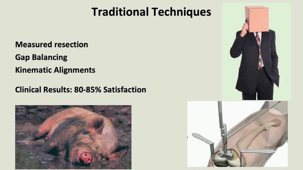 Improvements in TKA Stability: Importance of Balancing the Knee Joint ...