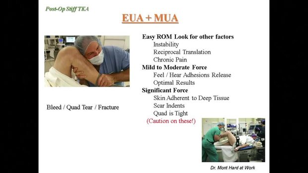 Post-Op Stiff TKA: When and How I Intervene | Vumedi