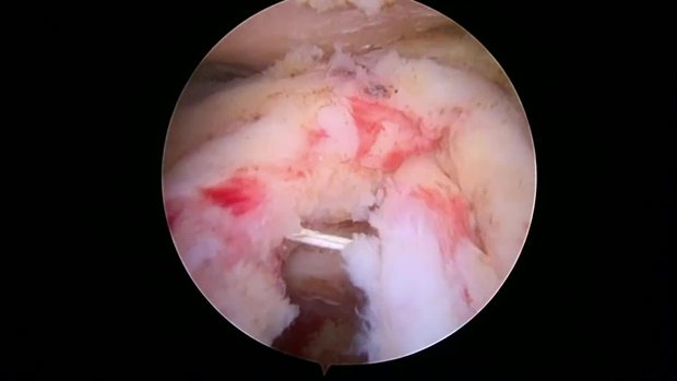 InSpace Subacromial Balloon Spacer Placement over a Revision Rotator ...