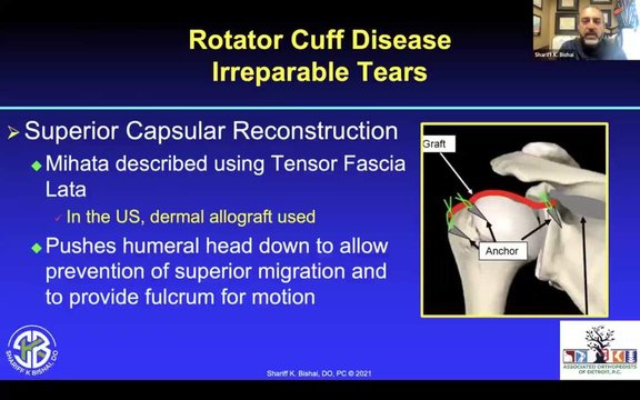 Advancements in Shoulder Arthroscopy: Large to Irreparable Rotator Cuff ...