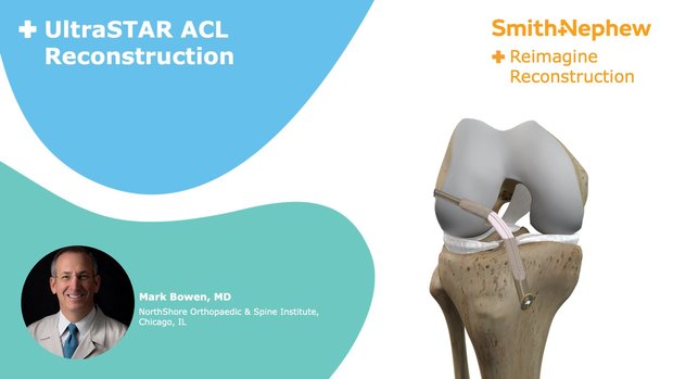 UltraSTAR (single tendon ACL reconstruction) Technique with ULTRABUTTON ...