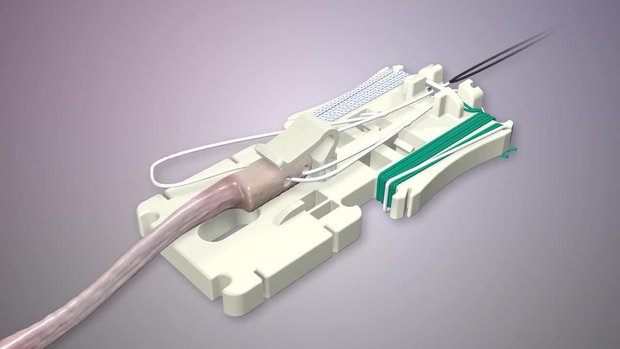 ACL Reconstruction with RIGIDLOOP™ BTB Adjustable Cortical System | Vumedi