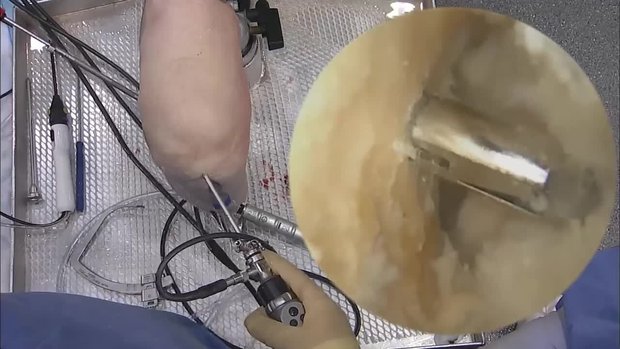 RIGIDLOOP™ BTB Adjustable Cortical System (3/3) | Vumedi