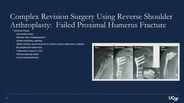 Complex Revision Surgery Using Reverse Shoulder Arthroplasty | Vumedi