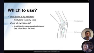 Tibial Fractures | VuMedi