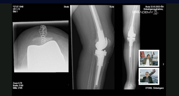 Pixee Medical Wins FDA Nod for AR Knee Replacement Tool