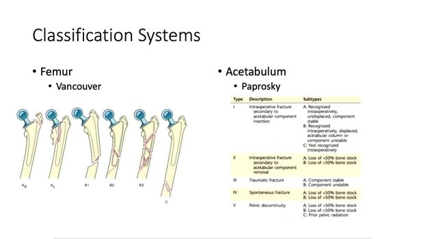 Periprosthetic Fracture About the Hip | Vumedi